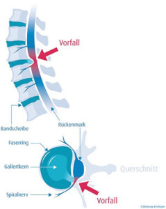 Diagram of a herniated disc